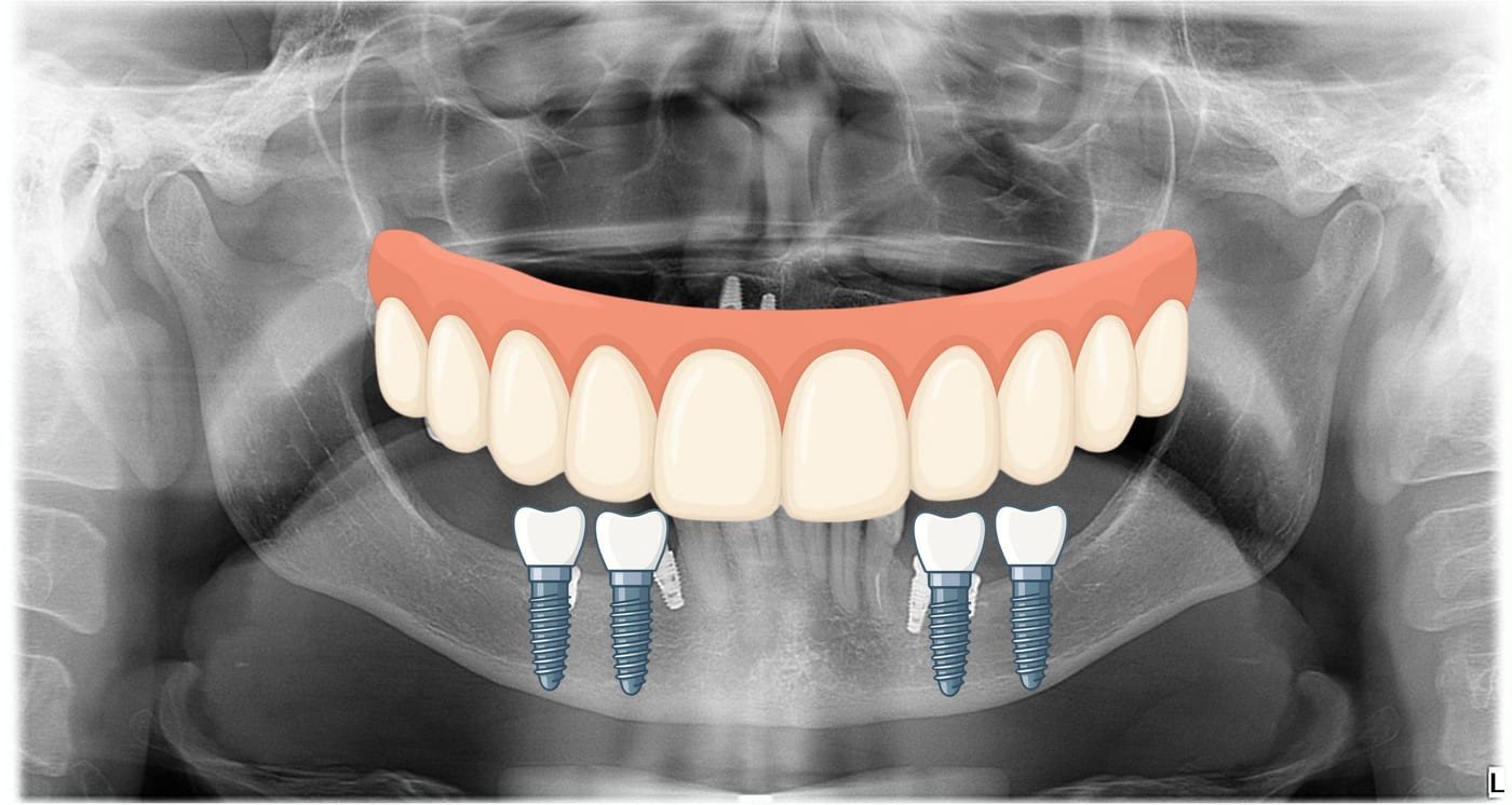 Radiografia panorâmica com implantes, coroas e protocolo posicionados no rad.IA